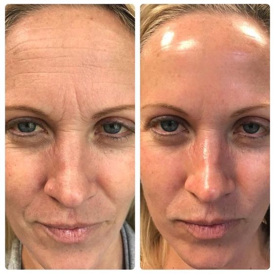 Velveta™ HydraGlow – Hyaluronic Acid Facial Mask
