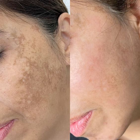 Velveta RadianceC™ – Vitamin C Facial Mask